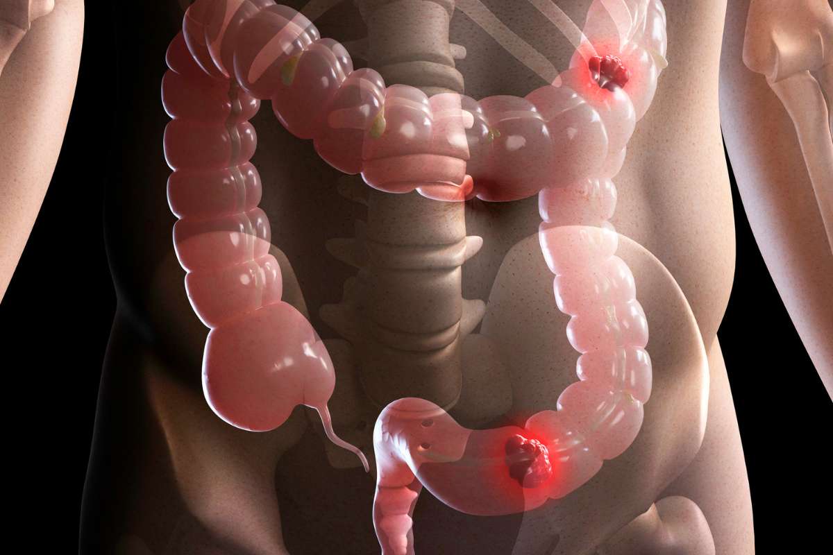 Inflammatory Bowel Disease (IBD) Treatment